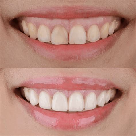 gummy smile before and after.